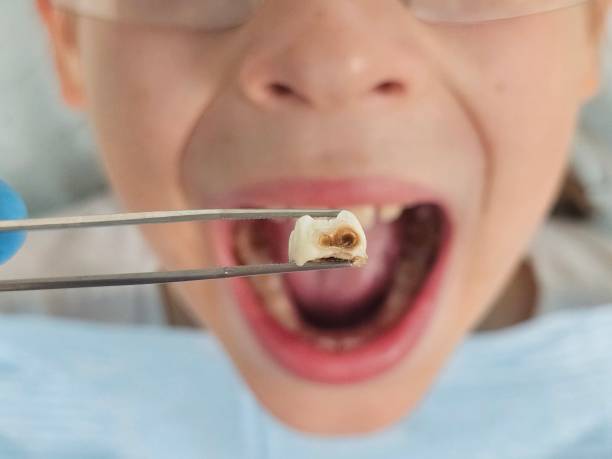 Best Emergency Tooth Extraction  in Hahnville, LA